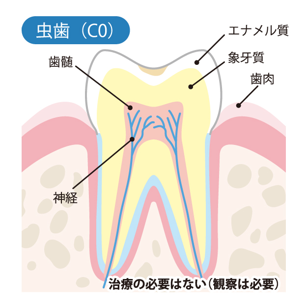 甲府市の歯医者、くまざわ歯科医院のむし歯治療