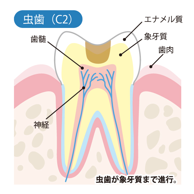 甲府市の歯医者、くまざわ歯科医院のむし歯治療