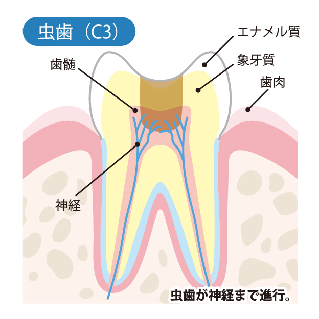 甲府市の歯医者、くまざわ歯科医院のむし歯治療