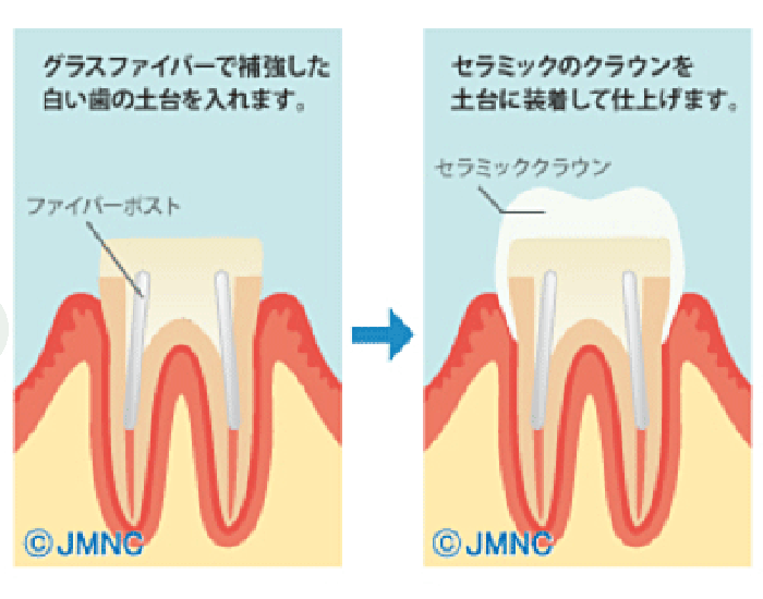 甲府市の歯医者、くまざわ歯科医院で根管治療