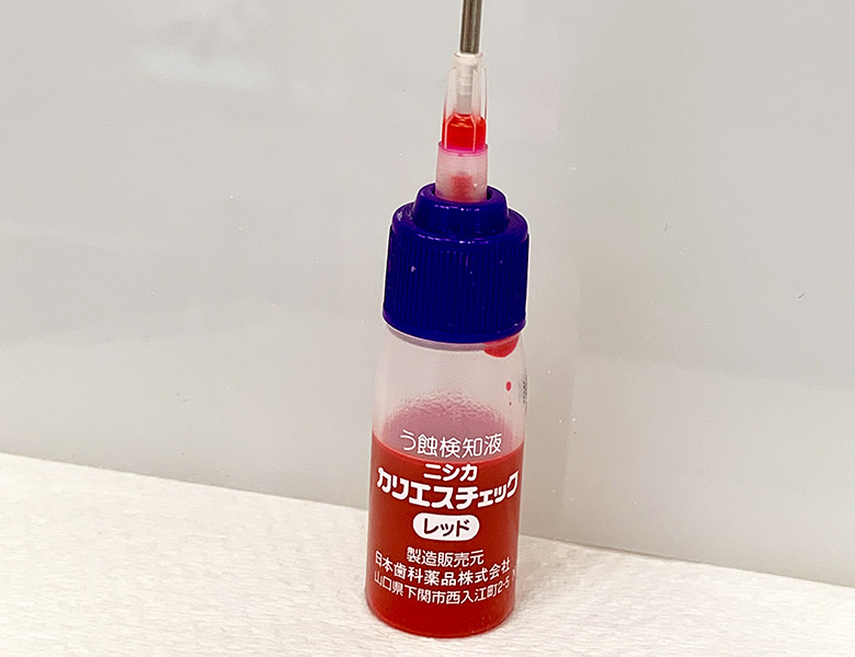 甲府市の歯医者、くまざわ歯科医院のむし歯治療