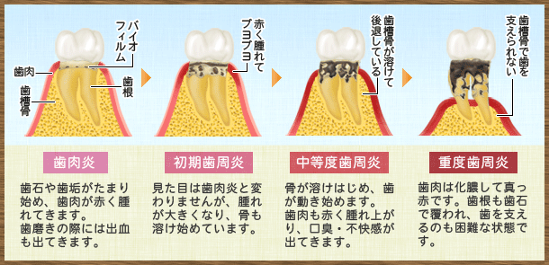 甲府市の歯医者、くまざわ歯科医院の歯周病治療